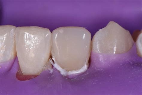 Enamel Dentin Fracture