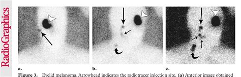 Figure 1 From Lymphoscintigraphy In Cutaneous Melanoma An Updated