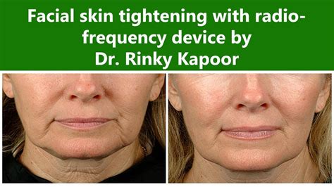 Radio Frequency Skin Tightening For Face The Esthetic Clinics India