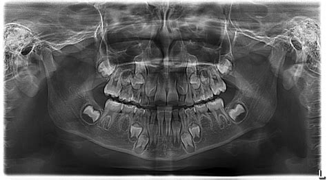 Panoramic Xray Digital Dentistry
