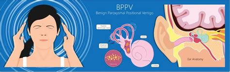 Benign Paroxysmal Positional Vertigo Bppv Ear Studio