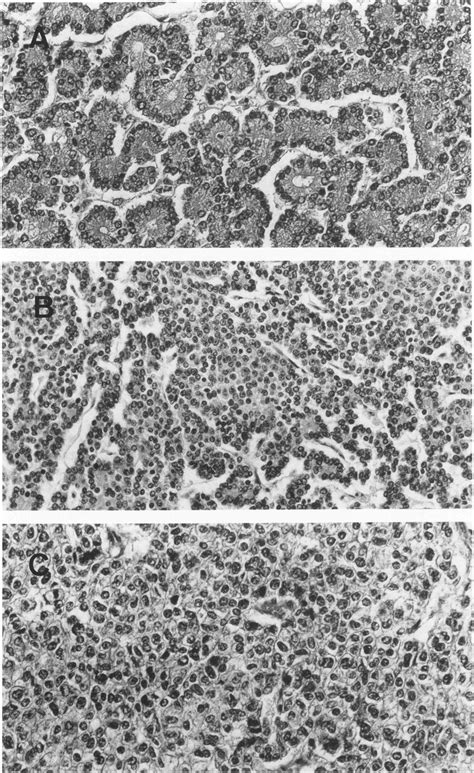 Histological Patterns Of Acinar Cell Carcinomas A Typical Acinar