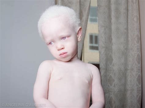Vitiligo Treatment Baby Boy Albino Men Melanism Ideal Beauty Rihanna Style Photo Series