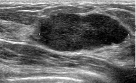 Infiltrating Ductal Carcinoma In A 17 Year Old Radiology Case