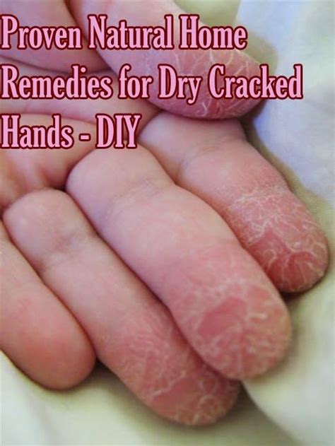 proven natural home remedies for dry cracked hands diy natural home remedies dry cracked
