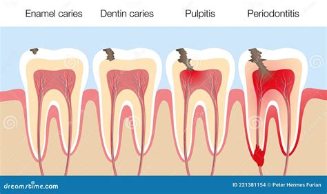 Teeth Caries Stages Pulpitis Periodontitis Enamel Caries Stock Vector
