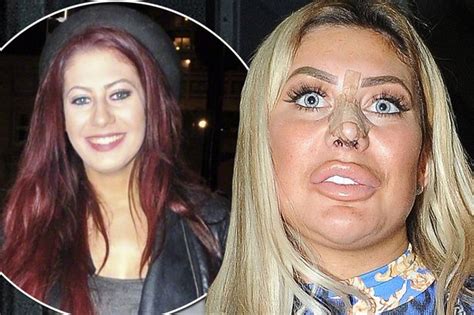 Shocking Before And After Pictures Show Chloe Ferrys Extreme