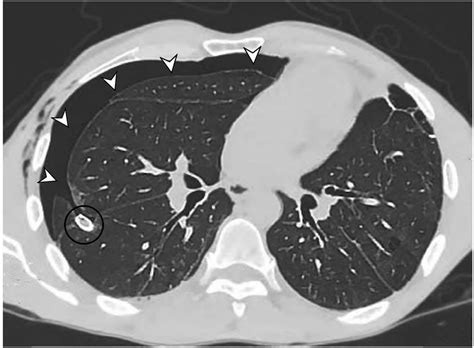Chest Ct Showing Right Sided Pneumothorax White Arrows Predominantly