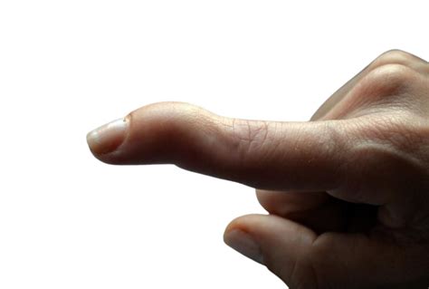 Mallet Finger Ladan Hajipour Hand And Wrist Surgeon