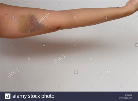 Bruise On Upper Arm