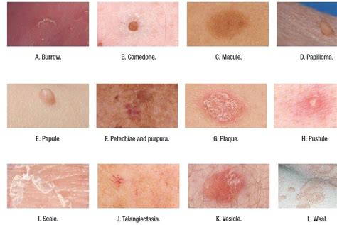 Medical Addicts Terms Used To Describe Skin Lesions Skin Ulcer