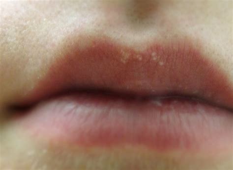 White Spots On Lips Pictures Treatment And Causes 2018 Updated