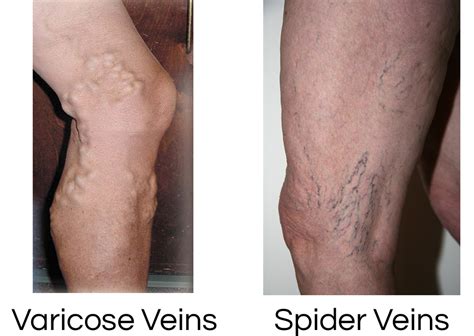 Vein Disorders — Vein Specialists Of Central Florida