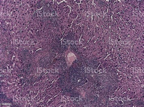 Human Pathology Foreign Body Granulome With Hemosiderin And Giant Cells