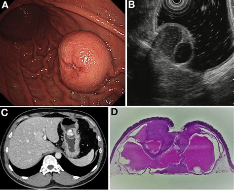 An Uncommon Gastric Submucosal Tumor With Mucosal Erosion Clinical
