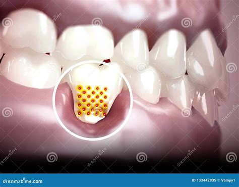 Mouth Teeth Gums Sensitive Teeth Withdrawal Of The Gingiva Dental