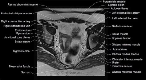 The tensor fascia lata and sartorious muscles originate from the anterior superior iliac spine. mri female pelvis anatomy axial image 16 | Pelvis anatomy ...