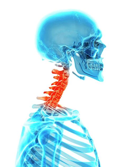Human Cervical Spine Pain Photograph By Sebastian Kaulitzkiscience