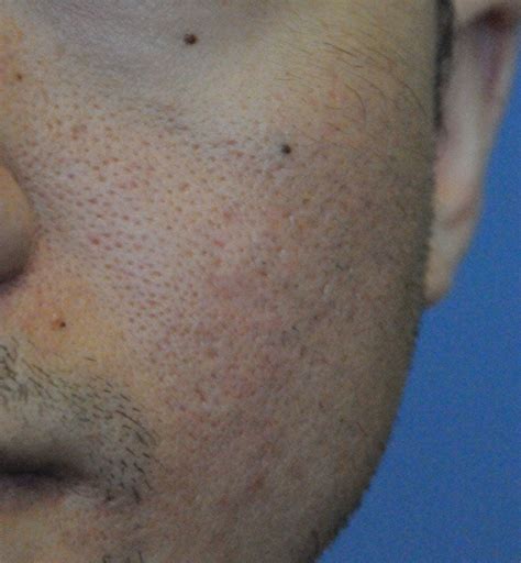 Acne Scar Treatment Before And After Photos Seattle Bellevue