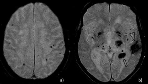 Nonconsecutive Gradient Echo Axial Magnetic Resonance Images A B