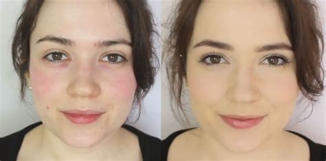 5 Easy Steps To Covering Up Redness With Makeup Best Makeup For Rosacea Rosacea Makeup