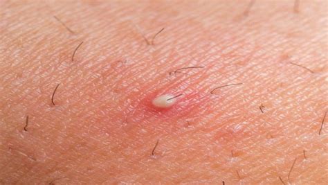 Ingrown Hair Cyst Causes Symptoms And Removal Treatment