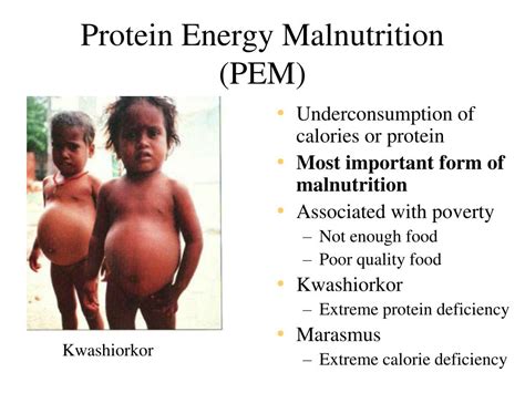 Ppt Malnutrition Powerpoint Presentation Free Download Id791012