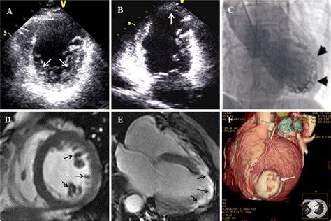 Noncompaction Cardiomyopathy With Apical Aneurysm International