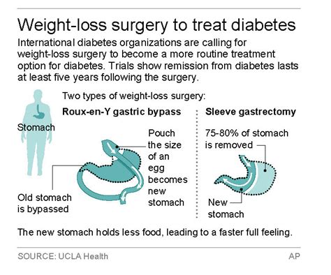 15 Inexpensive Weight Loss Surgery Requirements Best Product Reviews