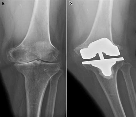 Early Femoral Condyle Insufficiency Fractures After Total Knee