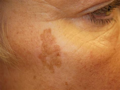 Liver Spots Vs Skin Cancer
