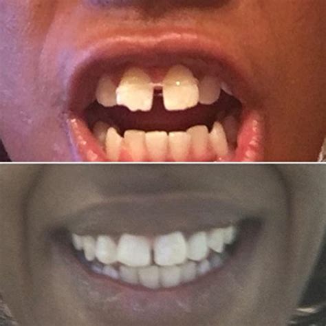 Teeth gaps can be fixed with different dental techniques. How To Use Rubber Bands To Close Gaps In Teeth - TeethWalls