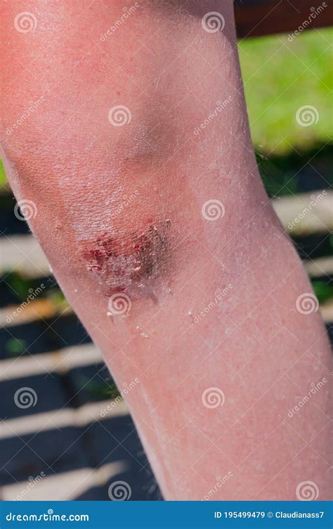 Close Up Of A Wound On A Child Knee Stock Image Image Of Girl Wound