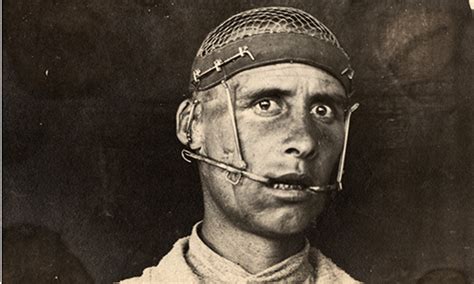 Reconstructiverestorativeplastic Surgery In The First World War