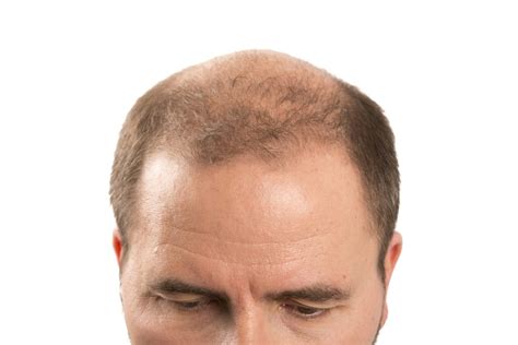 What Exactly Is Male Pattern Baldness Northwest Hair Restoration