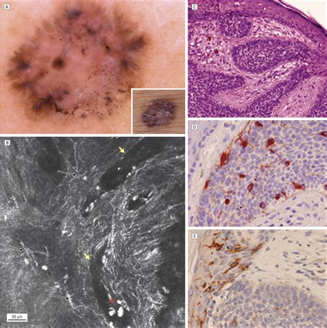 Dendritic Cells In Pigmented Basal Cell Carcinoma A Relevant Finding