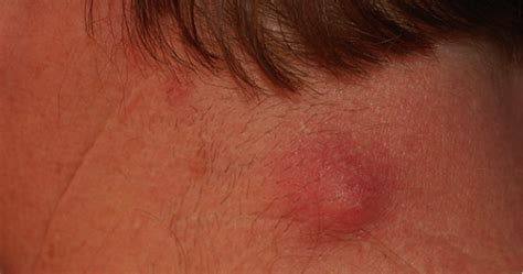 Infected Sebaceous Cyst —