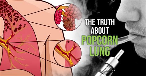 The Truth About Popcorn Lung With Reference Links Lizard Juice
