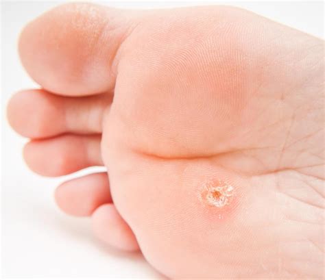 What Are The Effects Of Cimetidine For Warts With Pictures