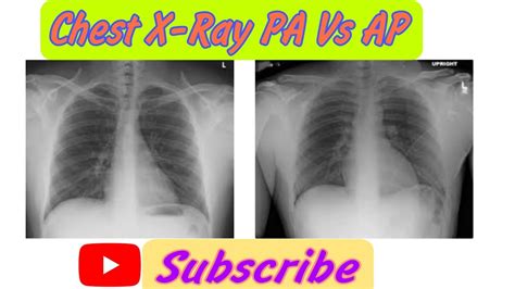 Pa Chest X Ray Vs Ap Chest X Ray How To Recognise Whether A Cxr Is Pa