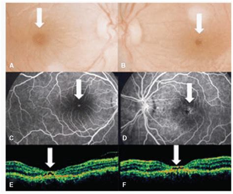 Macular Trauma Ento Key