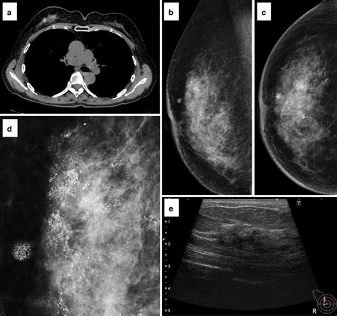 Radiological Images Of The Metastatic Ovarian Serous Carcinoma In The