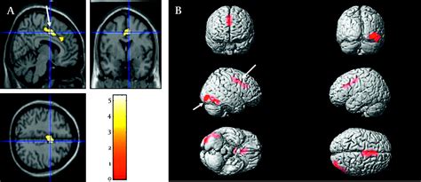 A Brain Pet Study In Patients With Narcolepsycataplexy Journal Of
