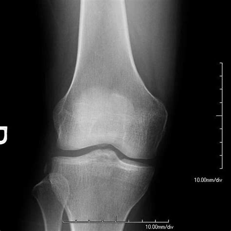 Proximal Tibial Fractures Dont Forget The Bubbles