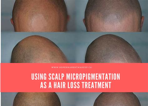Stopping hair loss is one thing, but what about strengthening the hair you many clinical studies do provide strong evidence that treating hair loss does lead to an increase in the number of hair follicles in balding areas on. Scalp Micropigmentation as a Hair Loss Treatment | HD ...