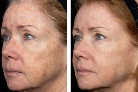 Fraxel Dual Laser Before After Serenity Medspa