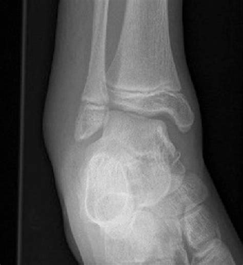 Right Ankle Plain Radiograph Demonstrating Talar Tilt And Increased