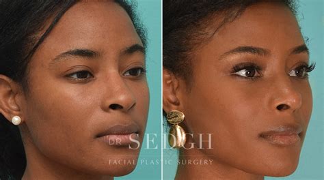 Black Rhinoplasty Before And After