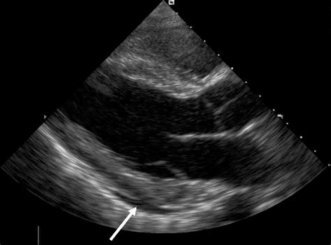 A Transthoracic Echocardiographic Parasternal Long Axis View Showing A Download Scientific