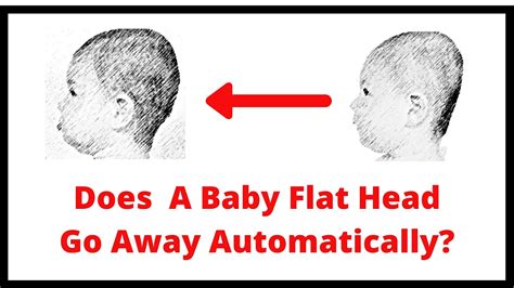 Does Baby Flat Head Go Away Automatically Baby Flat Head Syndrome